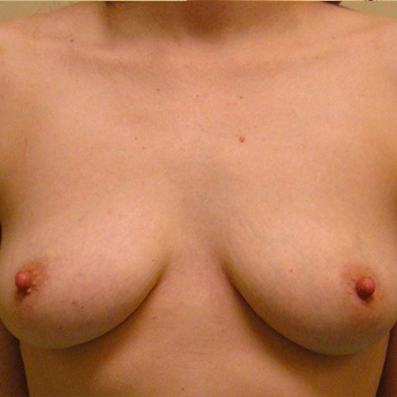 Saline Breast Augmentation Before & After Gallery - Patient 154948808 - Image 1