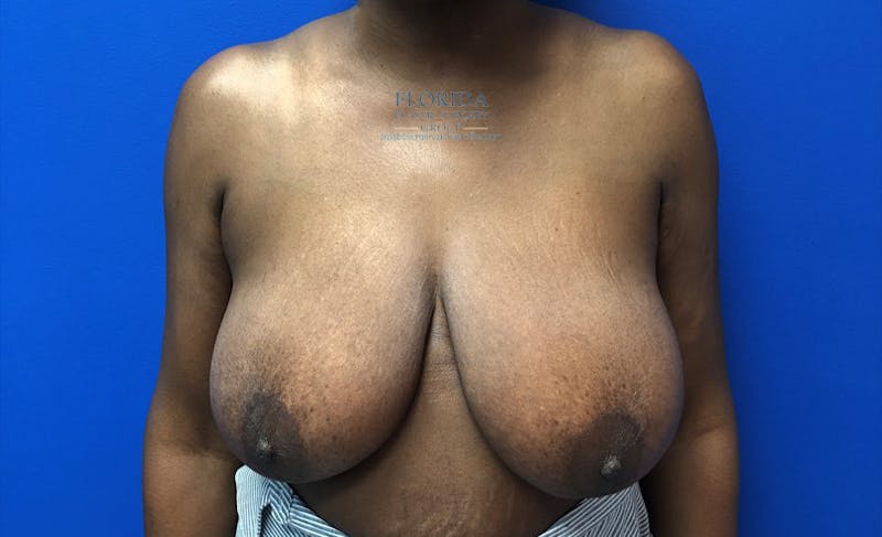 Breast Reduction Before & After Gallery - Patient 154948807 - Image 1