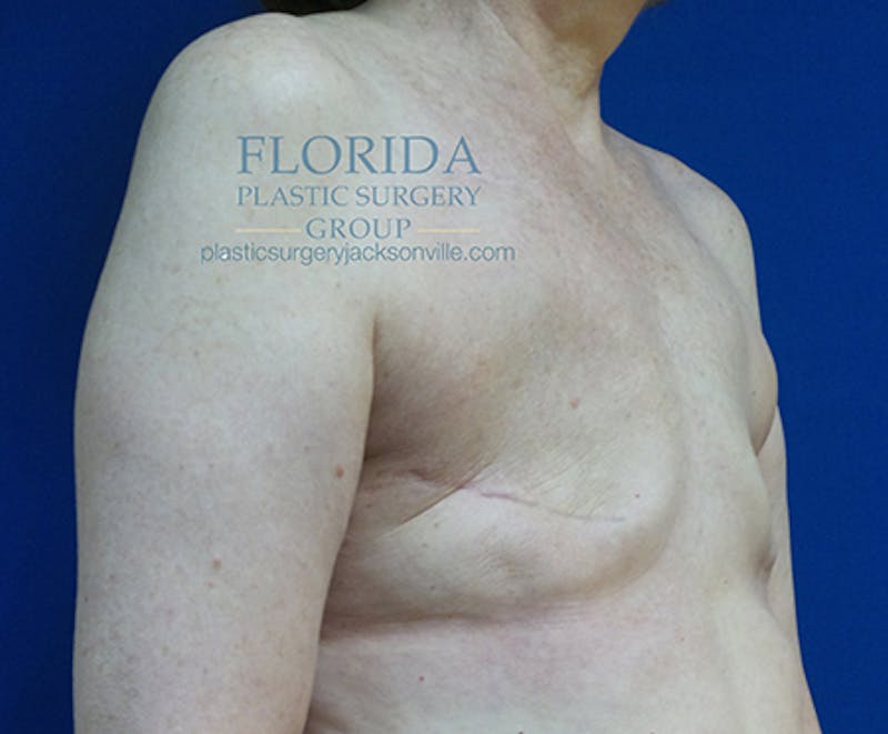 Latissimus Flap Reconstruction Before & After Gallery - Patient 154948812 - Image 5