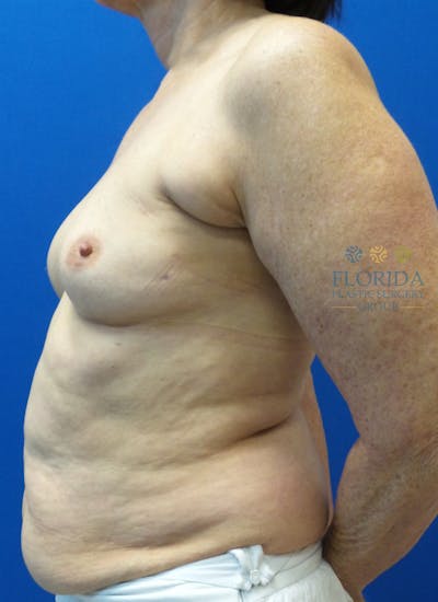 DIEP Flap Reconstruction Before & After Gallery - Patient 154948810 - Image 1