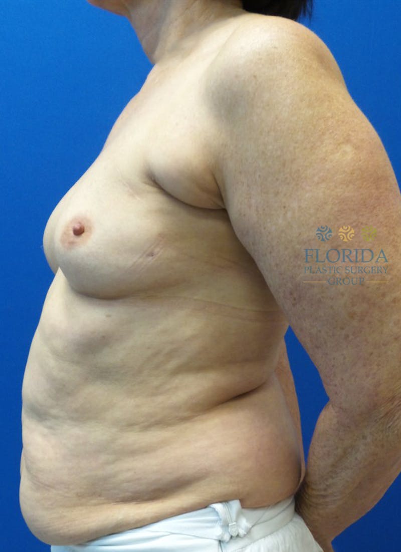 DIEP Flap Reconstruction Before & After Gallery - Patient 154948810 - Image 1