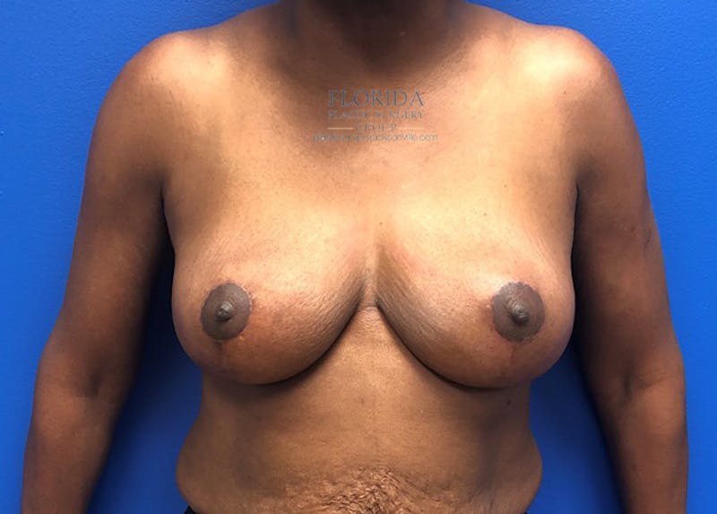 Breast Reduction Before & After Gallery - Patient 154948807 - Image 2
