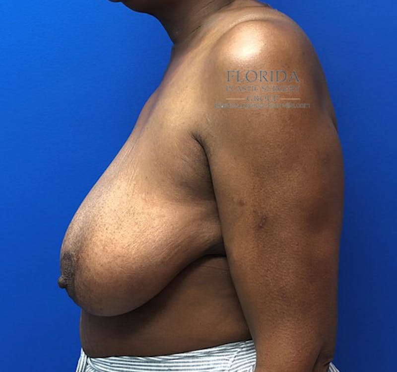 Breast Reduction Before & After Gallery - Patient 154948807 - Image 3