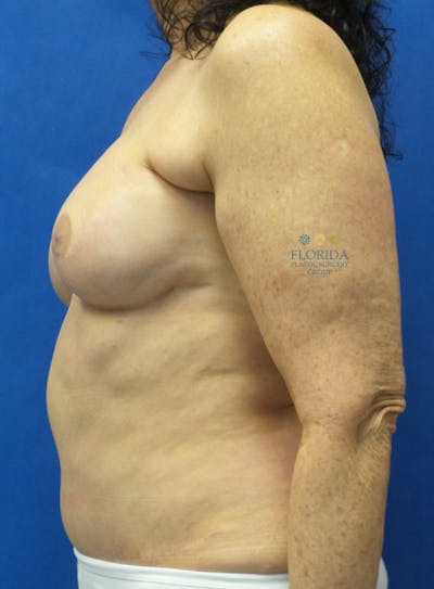 DIEP Flap Reconstruction Before & After Gallery - Patient 154948810 - Image 2