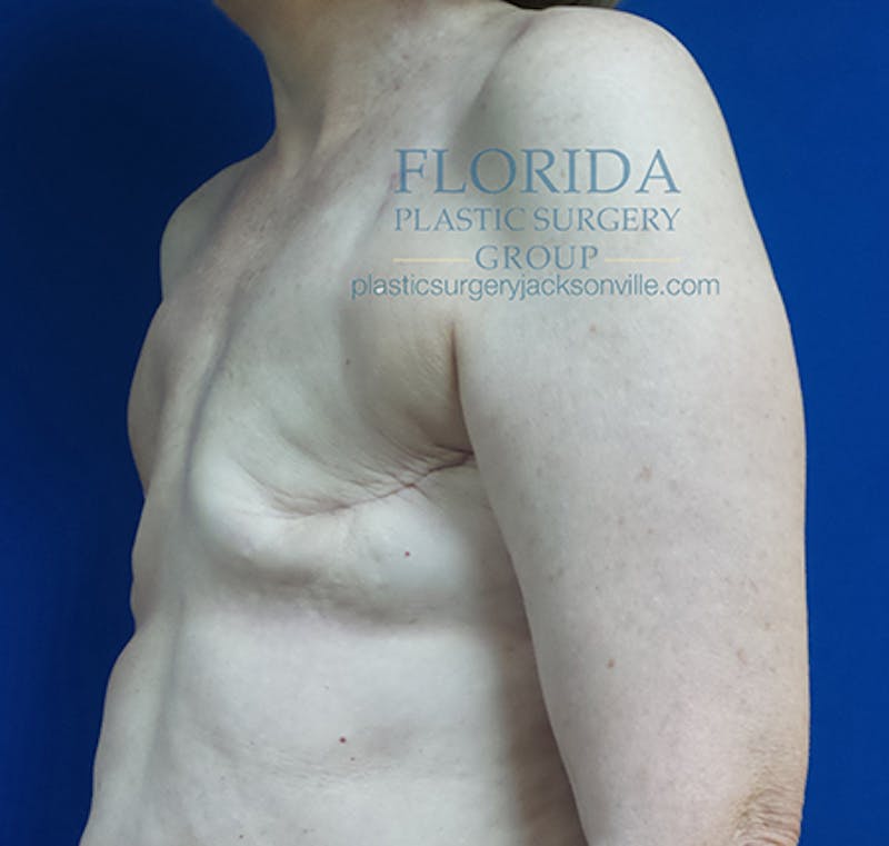 Latissimus Flap Reconstruction Before & After Gallery - Patient 154948812 - Image 7