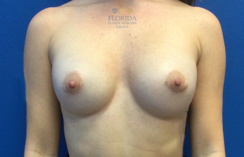 Breast Implant Removal Before & After Gallery - Patient 154948818 - Image 1