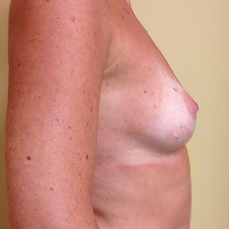 Nipple Sparing Breast Reconstruction Before & After Gallery - Patient 154948809 - Image 7