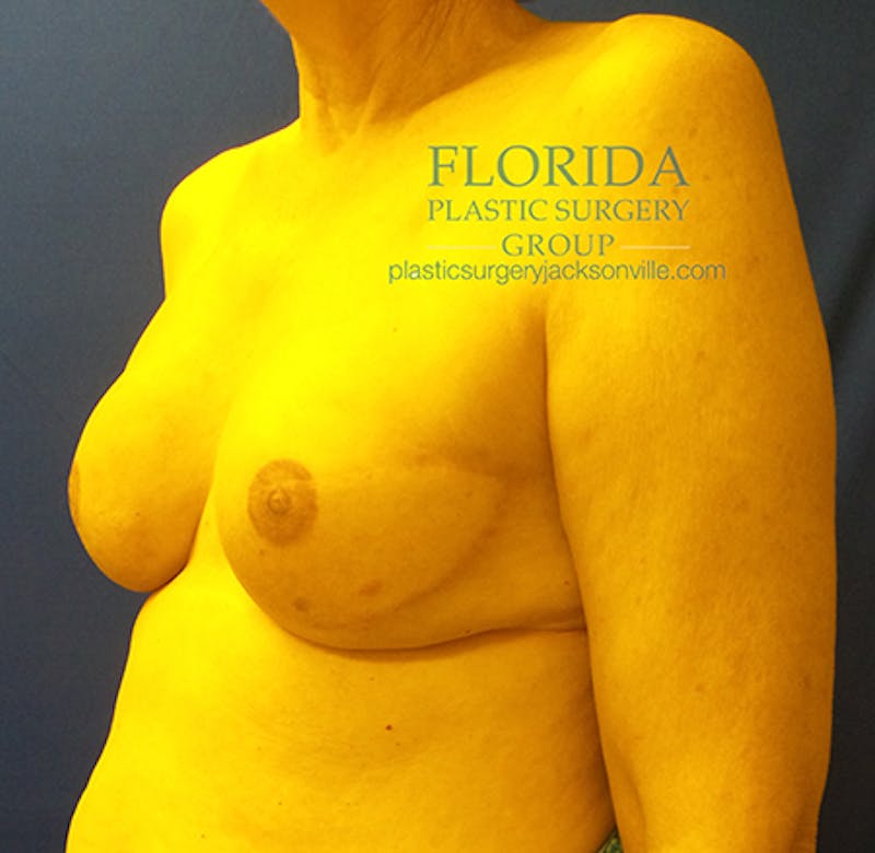 Latissimus Flap Reconstruction Before & After Gallery - Patient 154948812 - Image 8