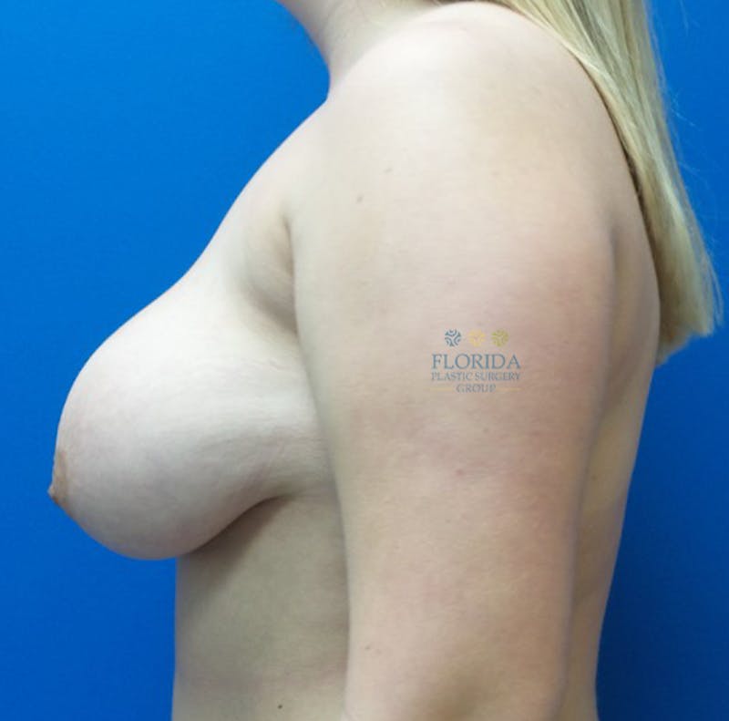 Breast Lift Before & After Gallery - Patient 154948811 - Image 3