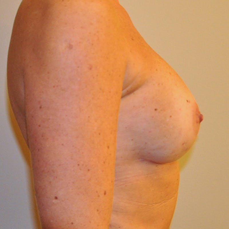 Nipple Sparing Breast Reconstruction Before & After Gallery - Patient 154948809 - Image 8