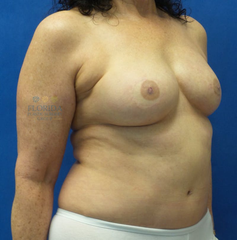 DIEP Flap Reconstruction Before & After Gallery - Patient 154948810 - Image 4