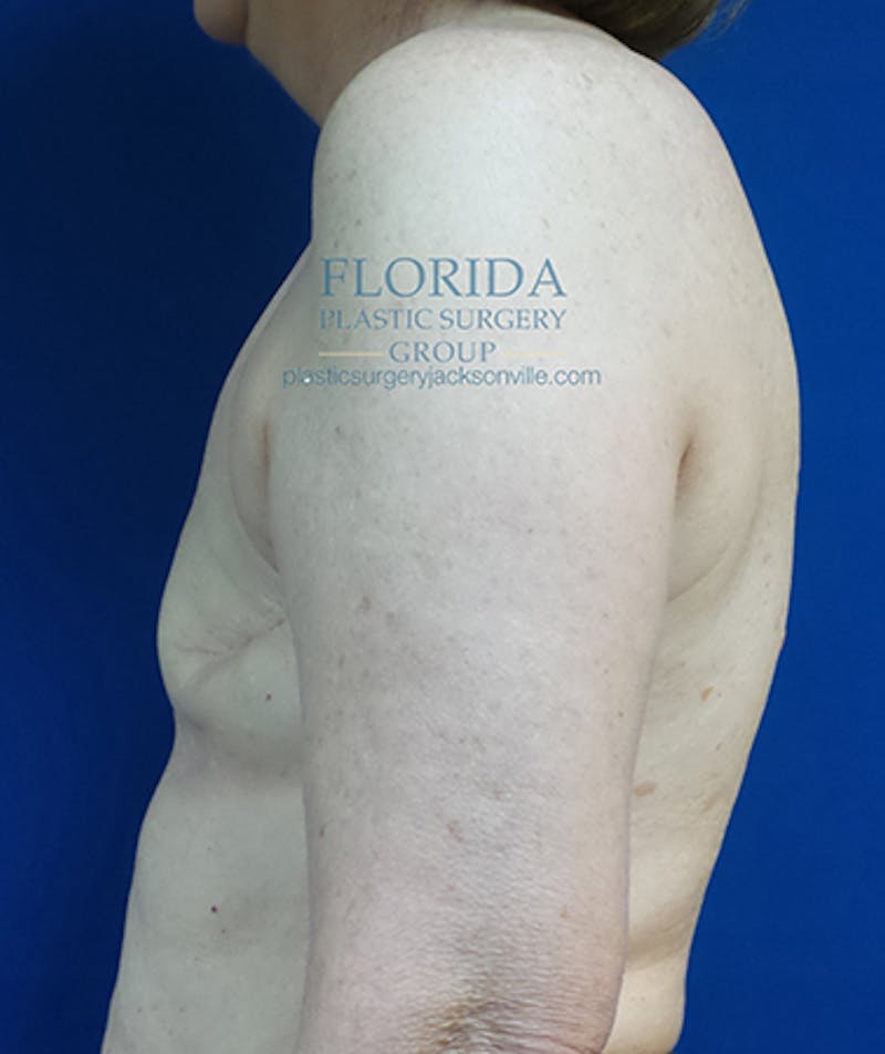 Latissimus Flap Reconstruction Before & After Gallery - Patient 154948812 - Image 9