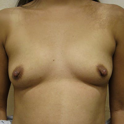 Nipple Sparing Breast Reconstruction Before & After Gallery - Patient 154948822 - Image 1