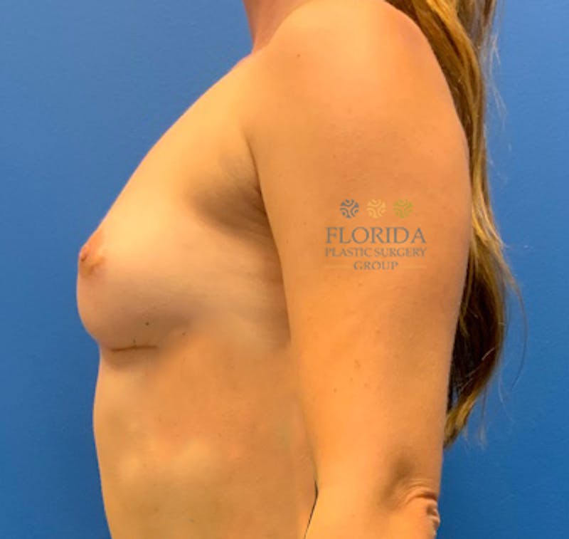Breast Implant Removal Before & After Gallery - Patient 154948818 - Image 4