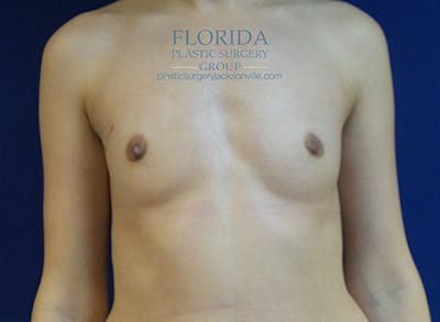 Latissimus Flap Reconstruction Before & After Gallery - Patient 154948835 - Image 1