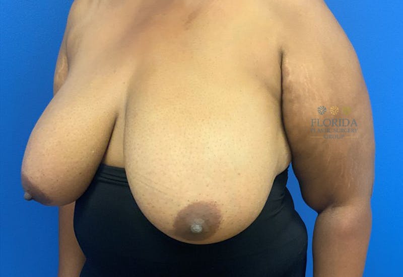 Breast Reduction Before & After Gallery - Patient 154948816 - Image 3