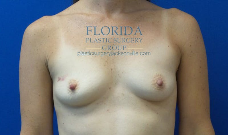 Silicone Breast Augmentation Before & After Gallery - Patient 154948827 - Image 1