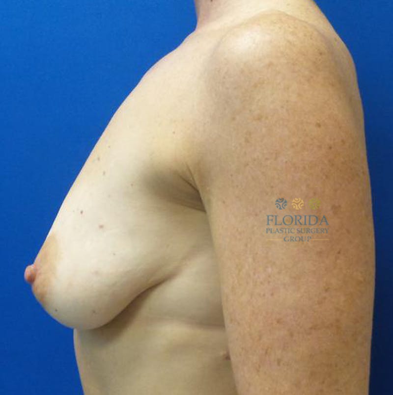 Post Lumpectomy Reconstruction Before & After Gallery - Patient 154948823 - Image 3