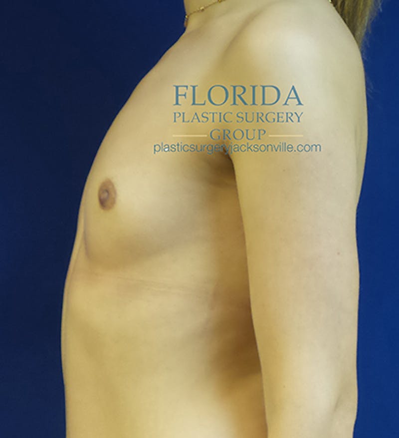Latissimus Flap Reconstruction Before & After Gallery - Patient 154948835 - Image 3
