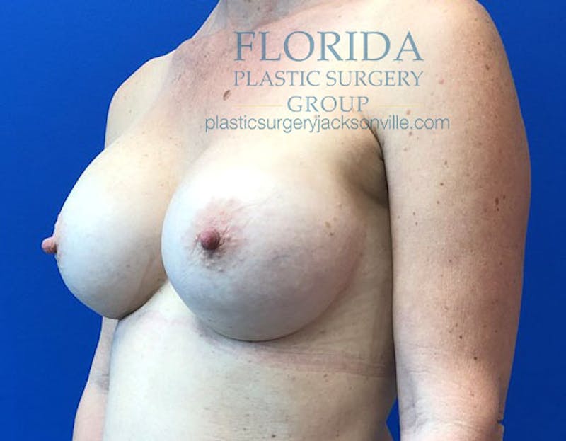 Silicone Breast Augmentation Before & After Gallery - Patient 154948827 - Image 4