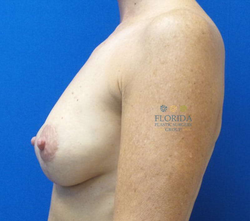 Post Lumpectomy Reconstruction Before & After Gallery - Patient 154948823 - Image 4