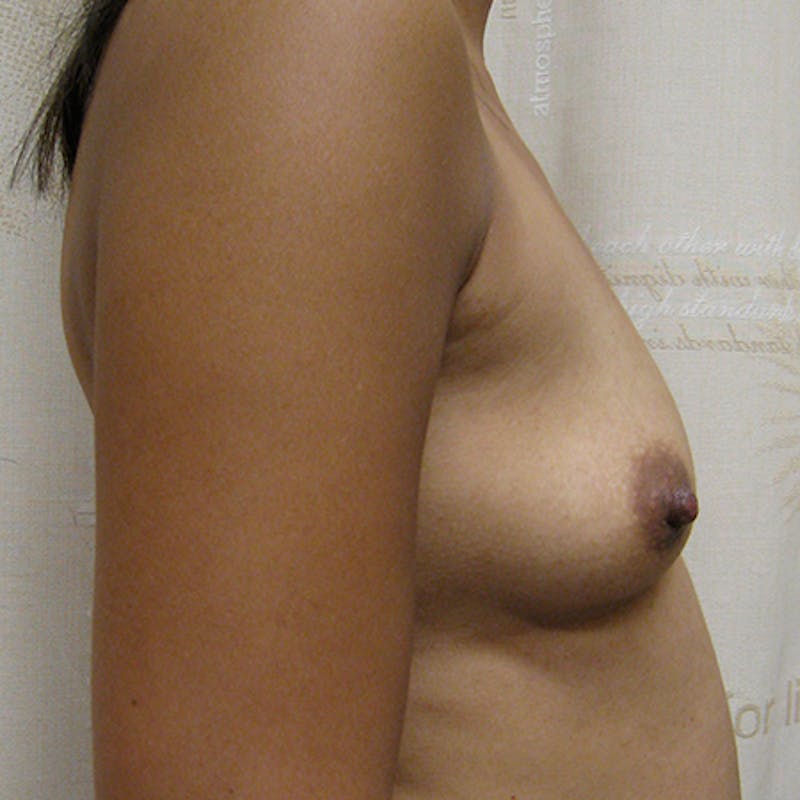 Nipple Sparing Breast Reconstruction Before & After Gallery - Patient 154948822 - Image 5