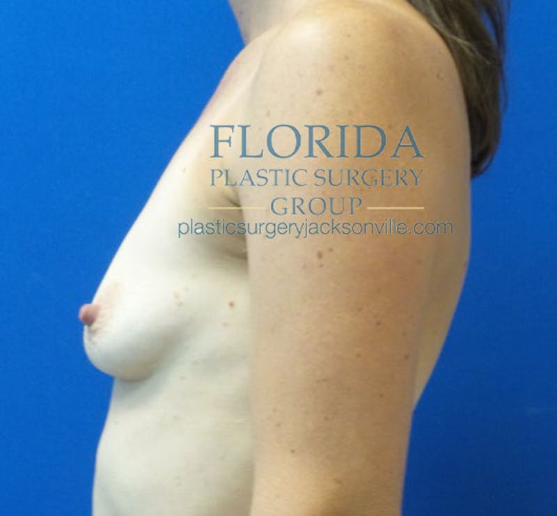 Silicone Breast Augmentation Before & After Gallery - Patient 154948827 - Image 5