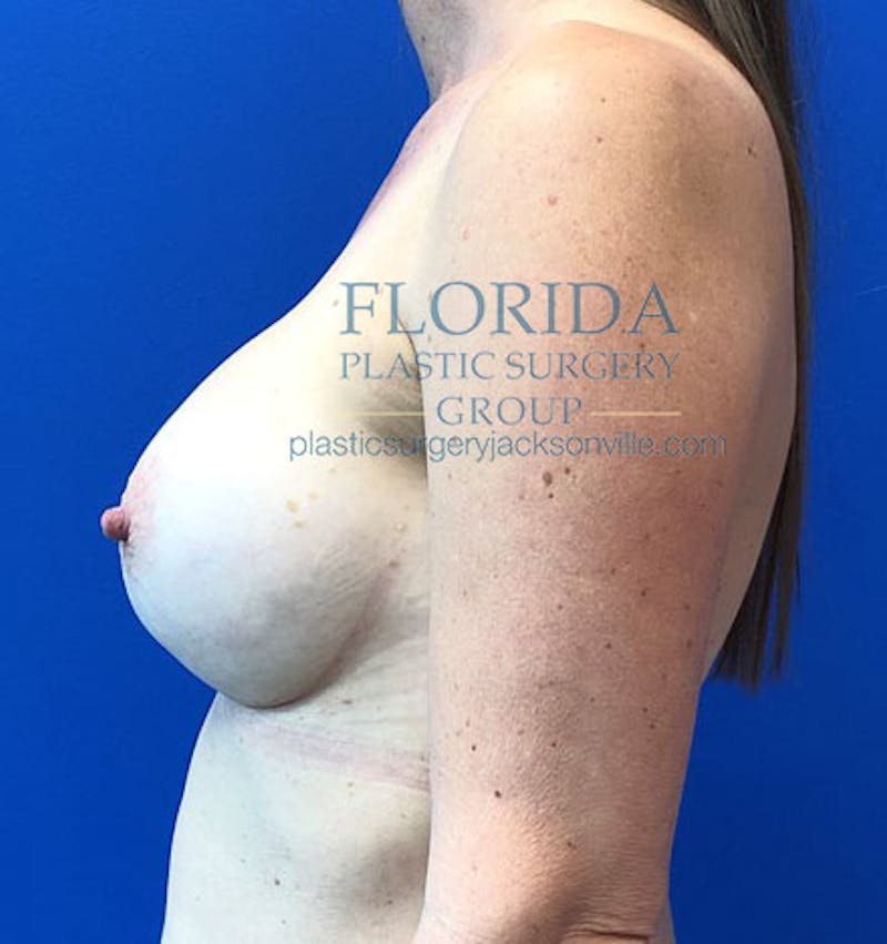 Silicone Breast Augmentation Before & After Gallery - Patient 154948827 - Image 6