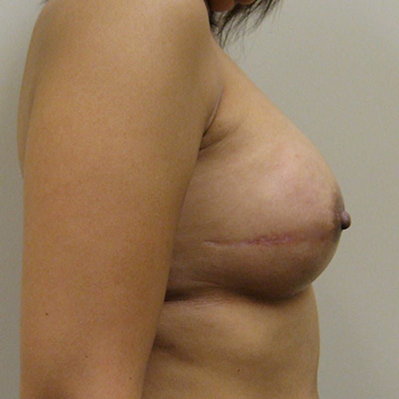 Nipple Sparing Breast Reconstruction Before & After Gallery - Patient 154948822 - Image 6