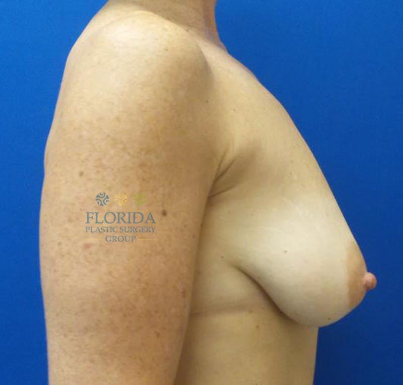 Post Lumpectomy Reconstruction Before & After Gallery - Patient 154948823 - Image 5