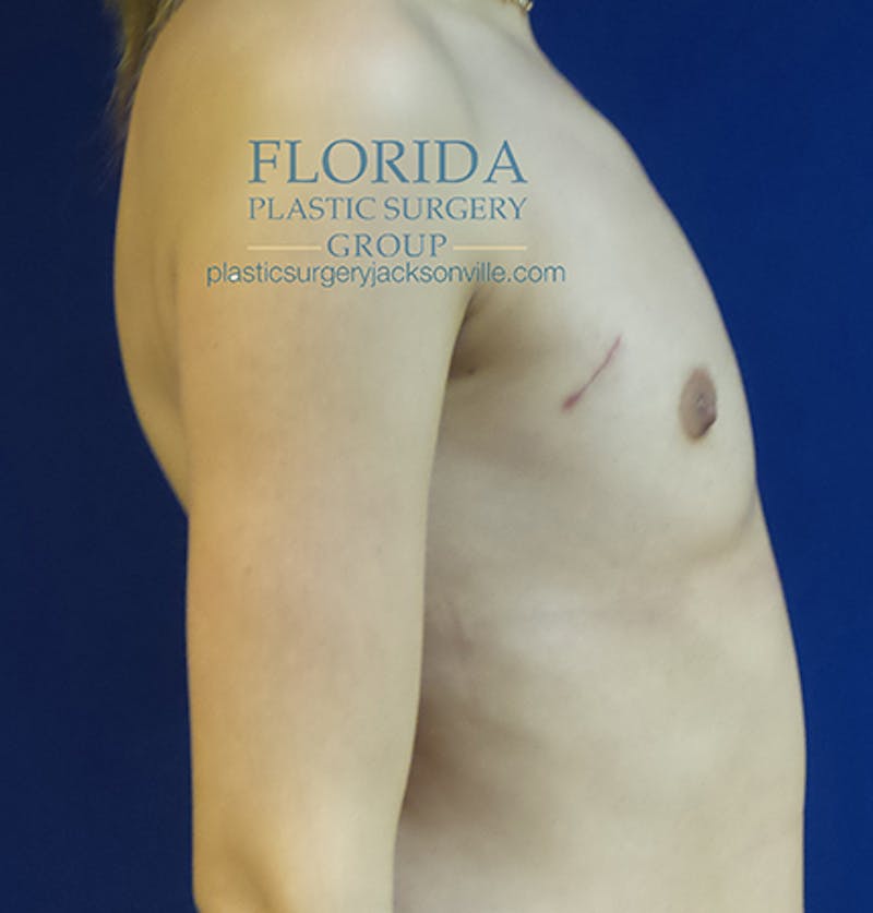 Latissimus Flap Reconstruction Before & After Gallery - Patient 154948835 - Image 5