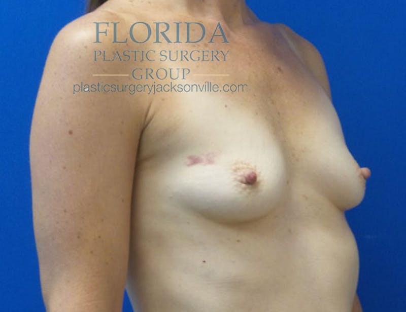 Silicone Breast Augmentation Before & After Gallery - Patient 154948827 - Image 7