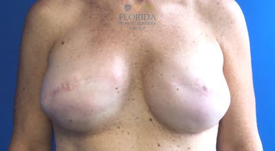 Direct to Implant Breast Reconstruction Before & After Gallery - Patient 154948832 - Image 1