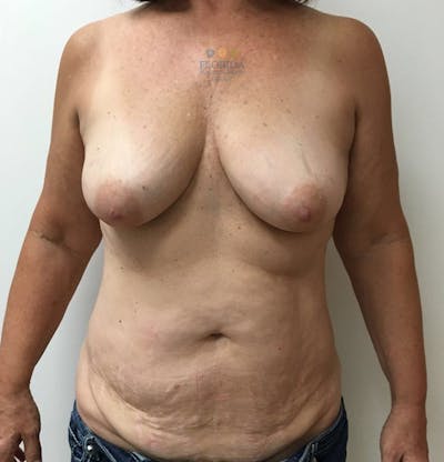 DIEP Flap Reconstruction Before & After Gallery - Patient 154948850 - Image 1