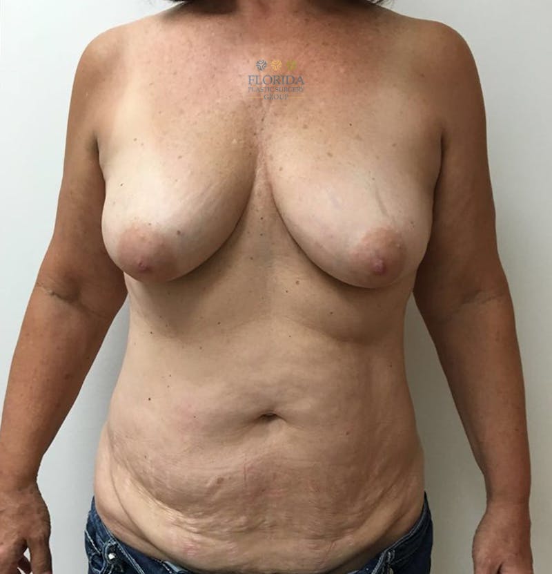 DIEP Flap Reconstruction Before & After Gallery - Patient 154948850 - Image 1