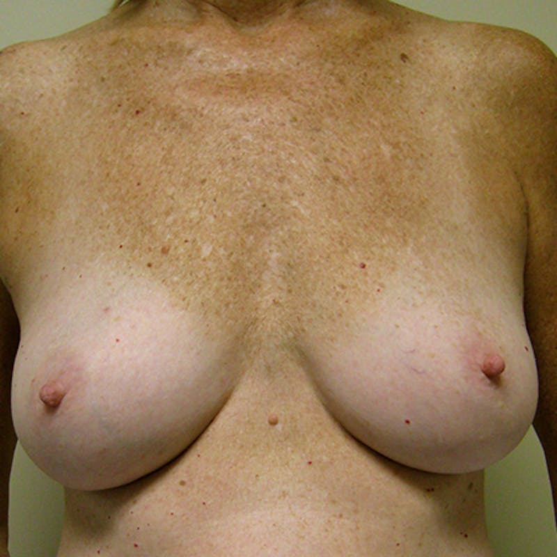 Nipple Sparing Breast Reconstruction Before & After Gallery - Patient 154948833 - Image 1