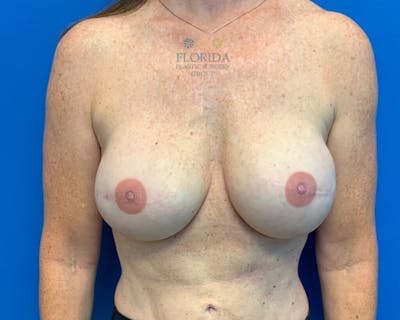 Tissue Expander Reconstruction Before & After Gallery - Patient 154948829 - Image 2