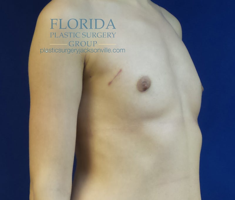Latissimus Flap Reconstruction Before & After Gallery - Patient 154948835 - Image 7