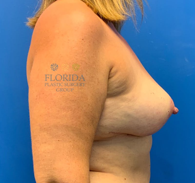 Breast Implant Removal Before & After Gallery - Patient 154948834 - Image 4