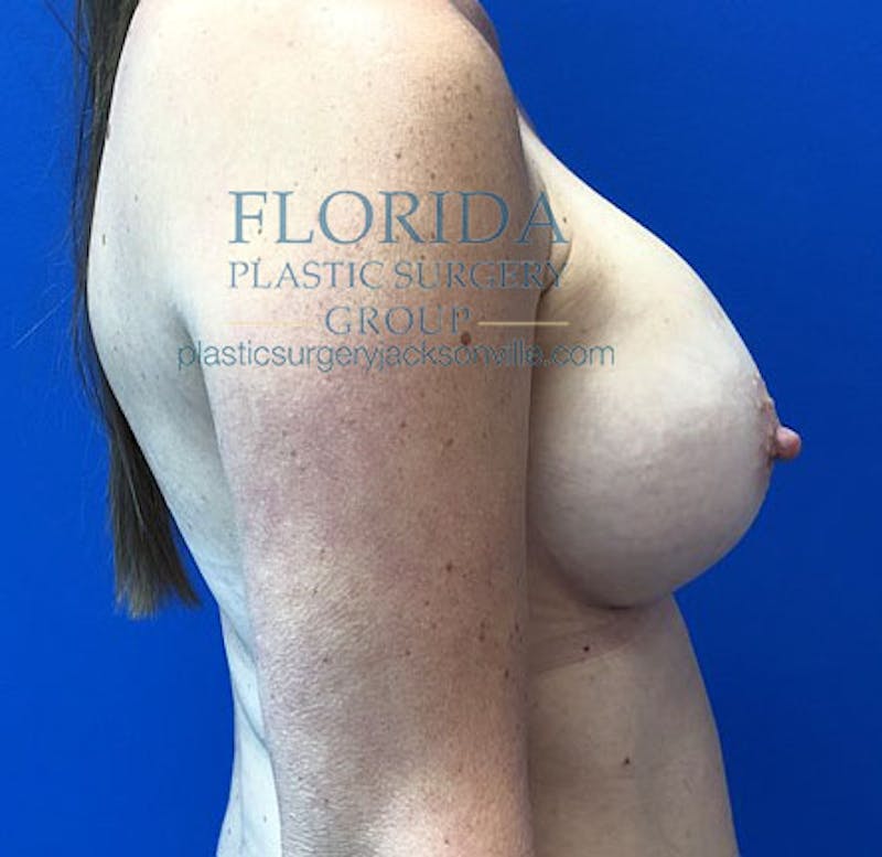 Silicone Breast Augmentation Before & After Gallery - Patient 154948827 - Image 10