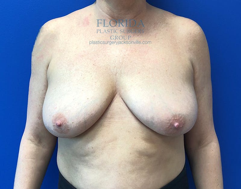Breast Lift Before & After Gallery - Patient 154948839 - Image 1