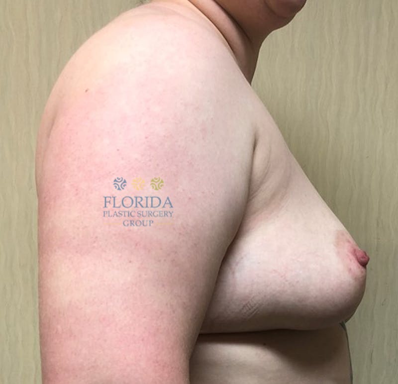 Augmentation Mastopexy Before & After Gallery - Patient 154948831 - Image 3