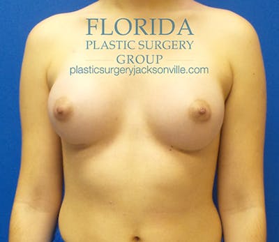 Saline Breast Augmentation Before & After Gallery - Patient 154948852 - Image 2