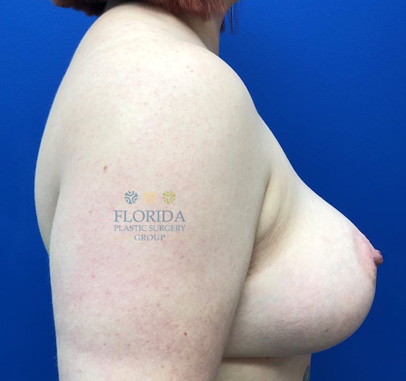Augmentation Mastopexy Before & After Gallery - Patient 154948831 - Image 4