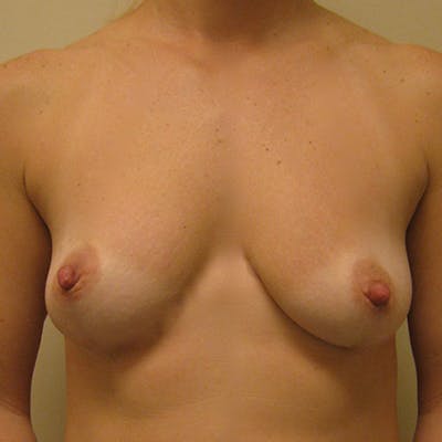 Silicone Breast Augmentation Before & After Gallery - Patient 154948840 - Image 1