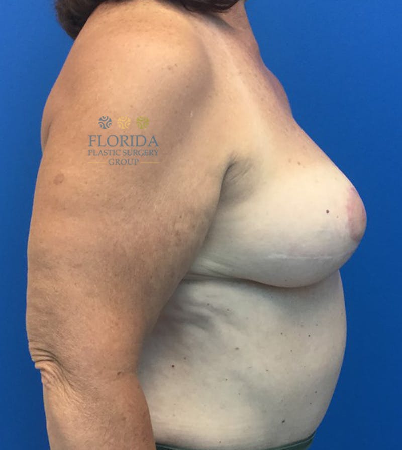 DIEP Flap Reconstruction Before & After Gallery - Patient 154948850 - Image 4