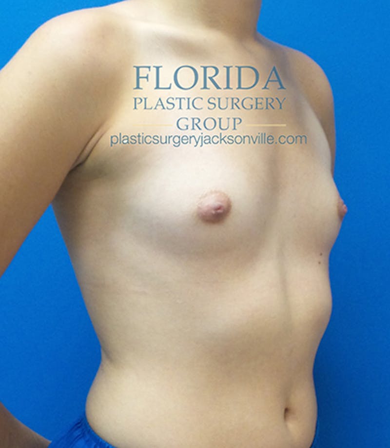 Saline Breast Augmentation Before & After Gallery - Patient 154948852 - Image 3