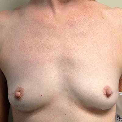 Nipple Sparing Breast Reconstruction Before & After Gallery - Patient 154948843 - Image 1