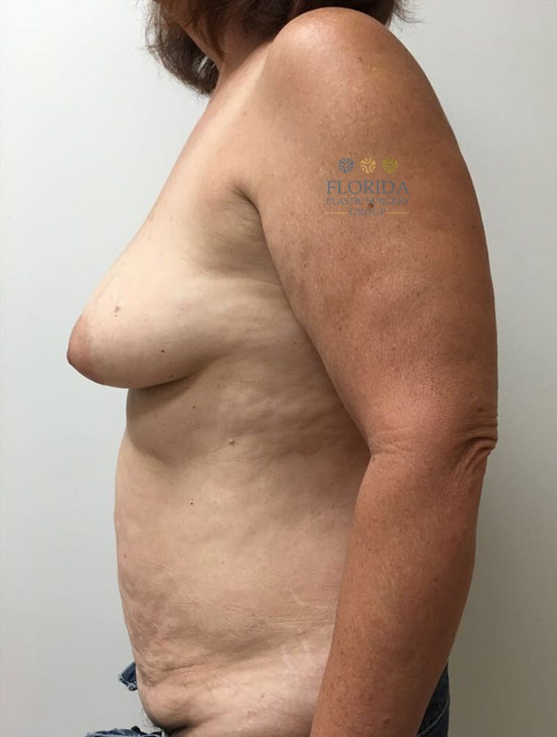 DIEP Flap Reconstruction Before & After Gallery - Patient 154948850 - Image 5