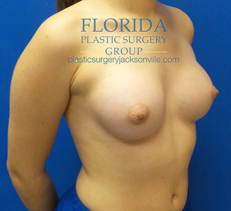 Saline Breast Augmentation Before & After Gallery - Patient 154948852 - Image 4
